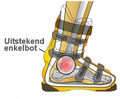 Uitstekend enkelbot