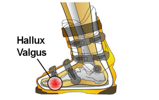 Hallus Valgus skischoen