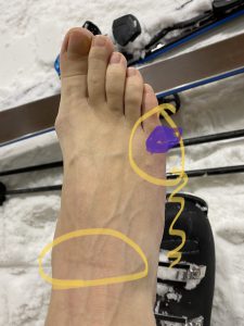 foto van voet na het skiën