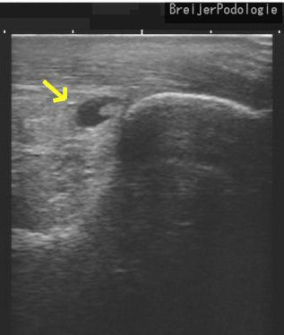 echo retrocalcaneale bursitis