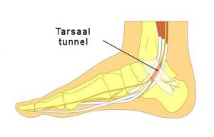 Tarsaal tunnel syndroom