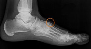 X-ray foto tarsal boss