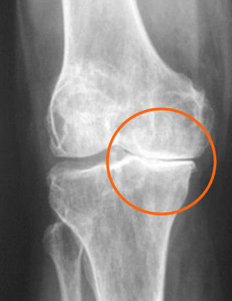 X-ray knieartrose röntgenfoto